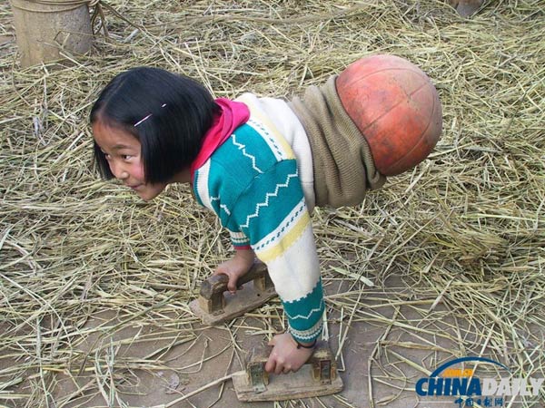 The basketball girl moves with the assistance of wooden aids, January, 2005. [Photo/chinadaily.com.cn]  