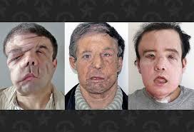 French man becomes world's first person to undergo two face transplants 