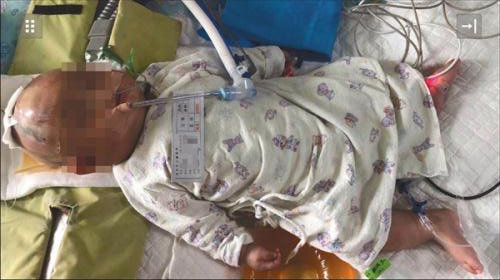A three-month baby girl falls into coma after being struck by an apple that had fallen from a skyscraper in Tangxia Town, Dongguan City of Guangdong Province. (Photo provided by the girl's family)
