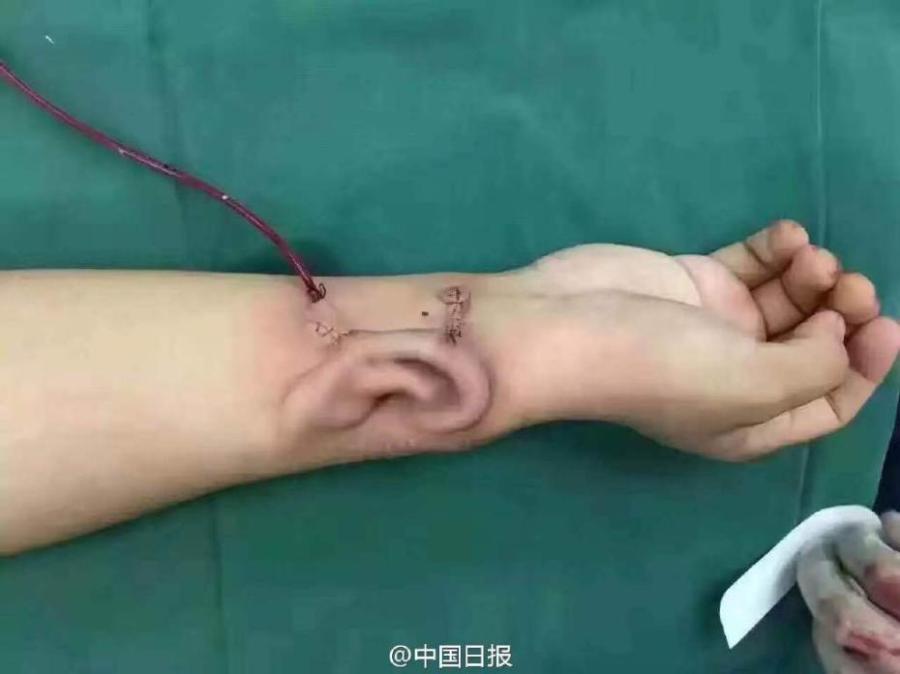 doctor grows new ear on mans arm to restore his hearing(1/4)